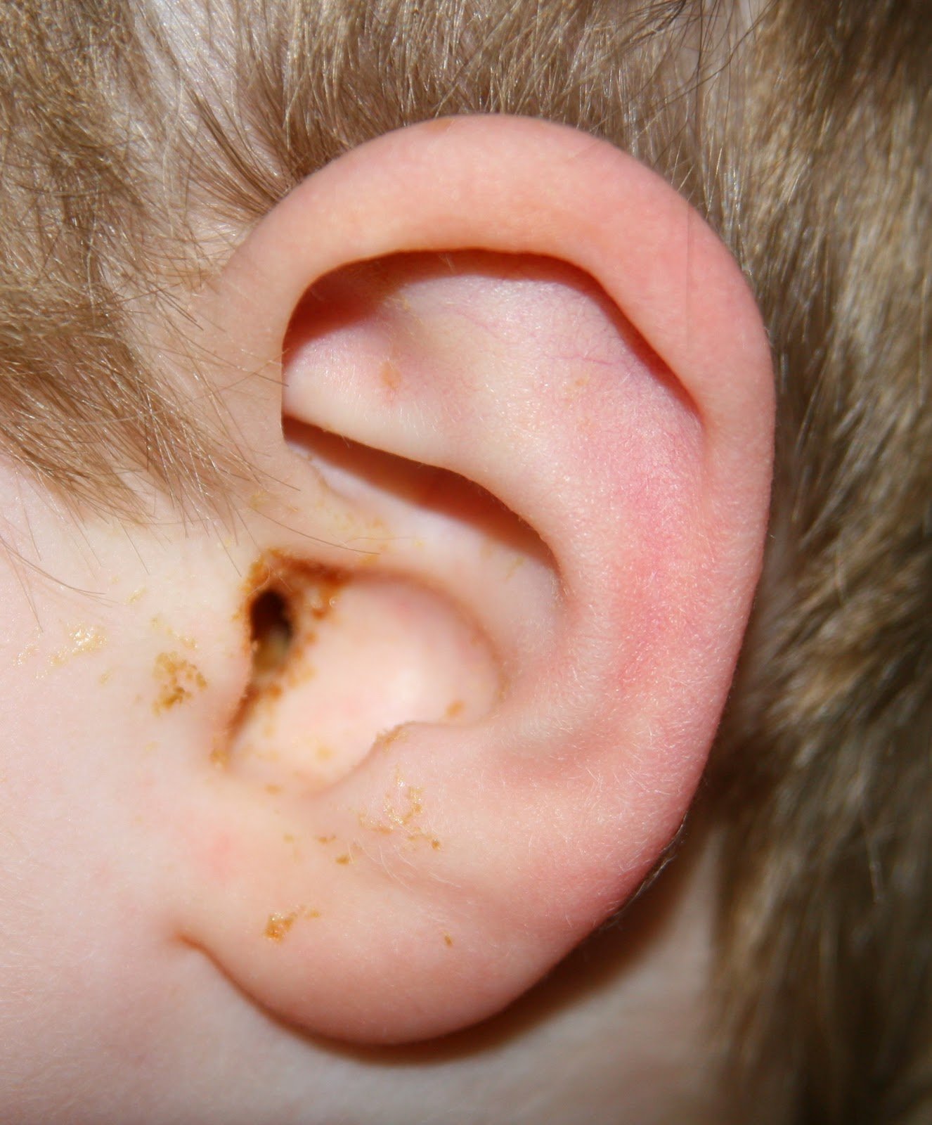 Say What?: Rats (Another Ear Infection)