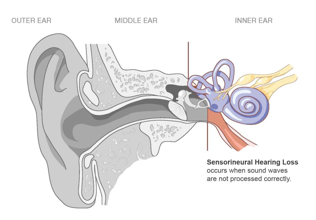 Sensorineural hearing loss and It?s Causes