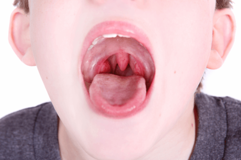 Should I have my tonsils removed?