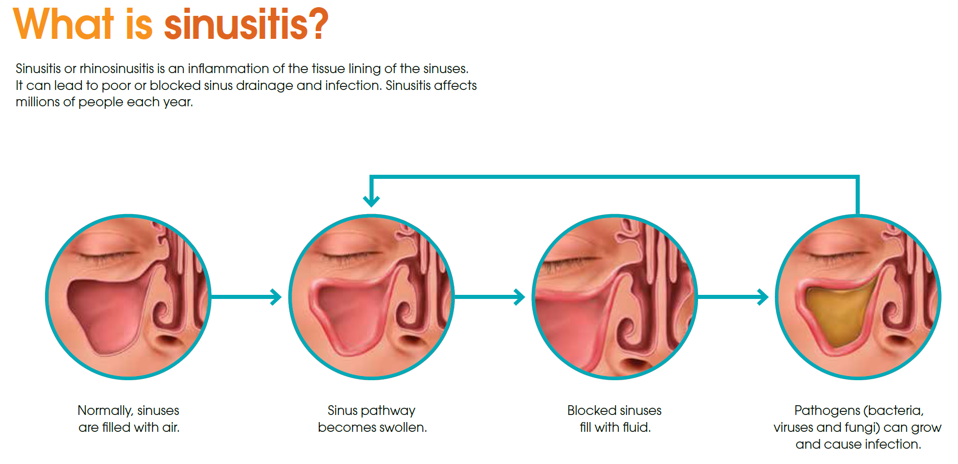 Sinus Infection Light Headed Symptoms