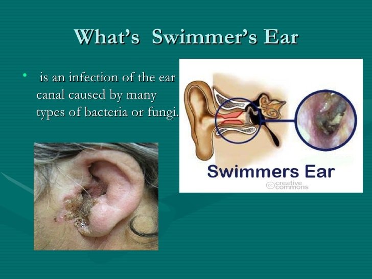 Swimmers ear roberto