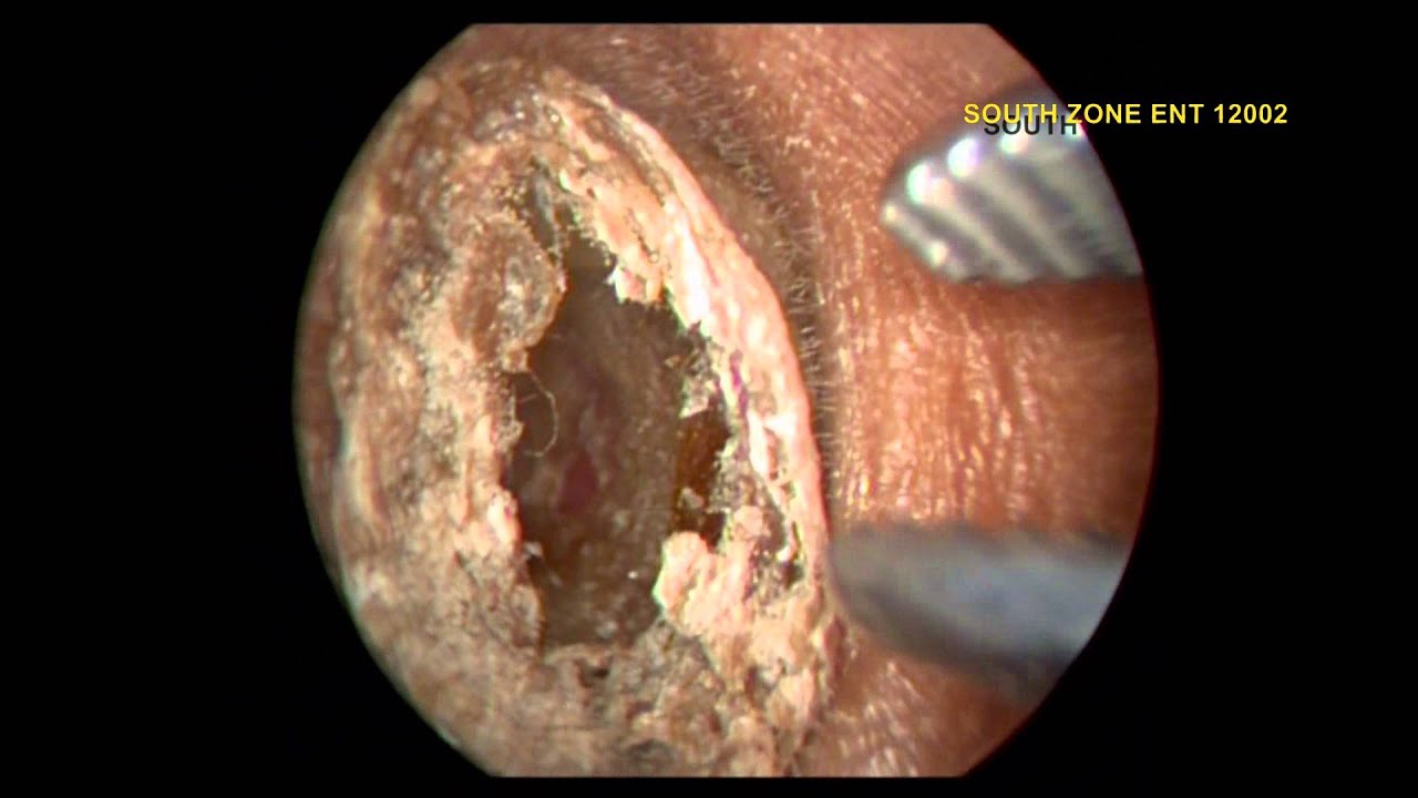 THE MOULDED EAR IMPACTED WAX