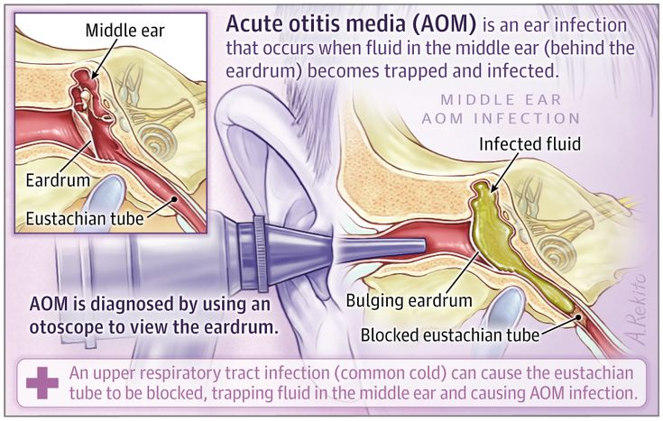 This Patient Page describes risk factors for acute otitis ...