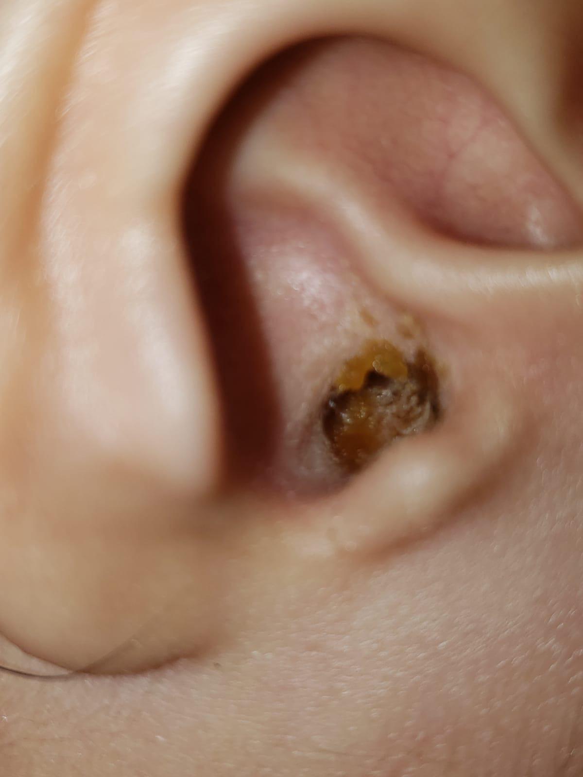 Two year old daughterâs ear, one week after ear infection ...