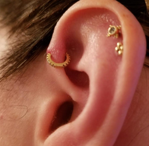 What Does An Infected Ear Piercing Look Like?